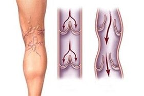 odtok krvi v krčnih žilah na različnih stopnjah razvoja bolezni